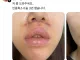 쓰레드에서 핫한 인중축소 성형수술 피해자...jpg